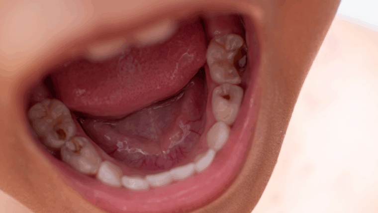 ¿Cómo Evitar las Caries? Guía Completa para una Boca Sana