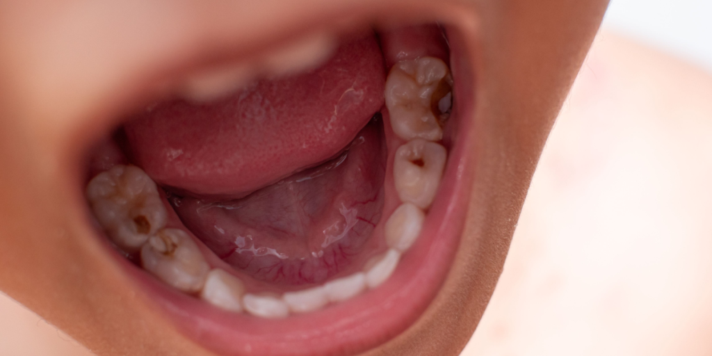 ¿Cómo Evitar las Caries? Guía Completa para una Boca Sana